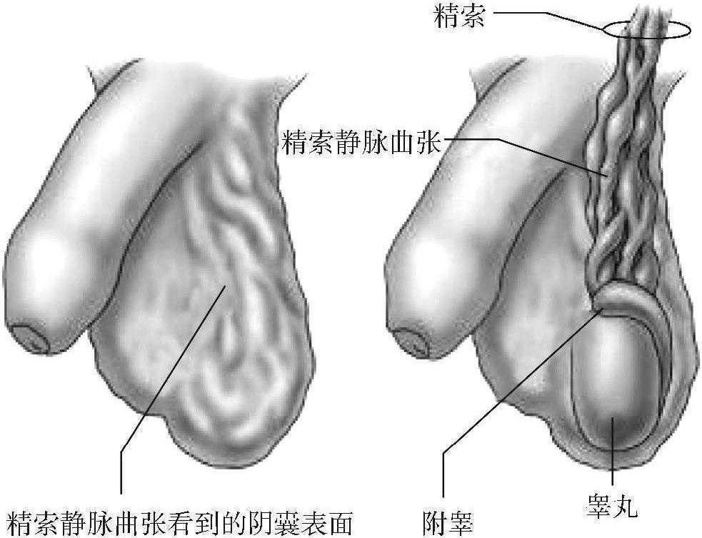 精索靜脈曲張與男性不育